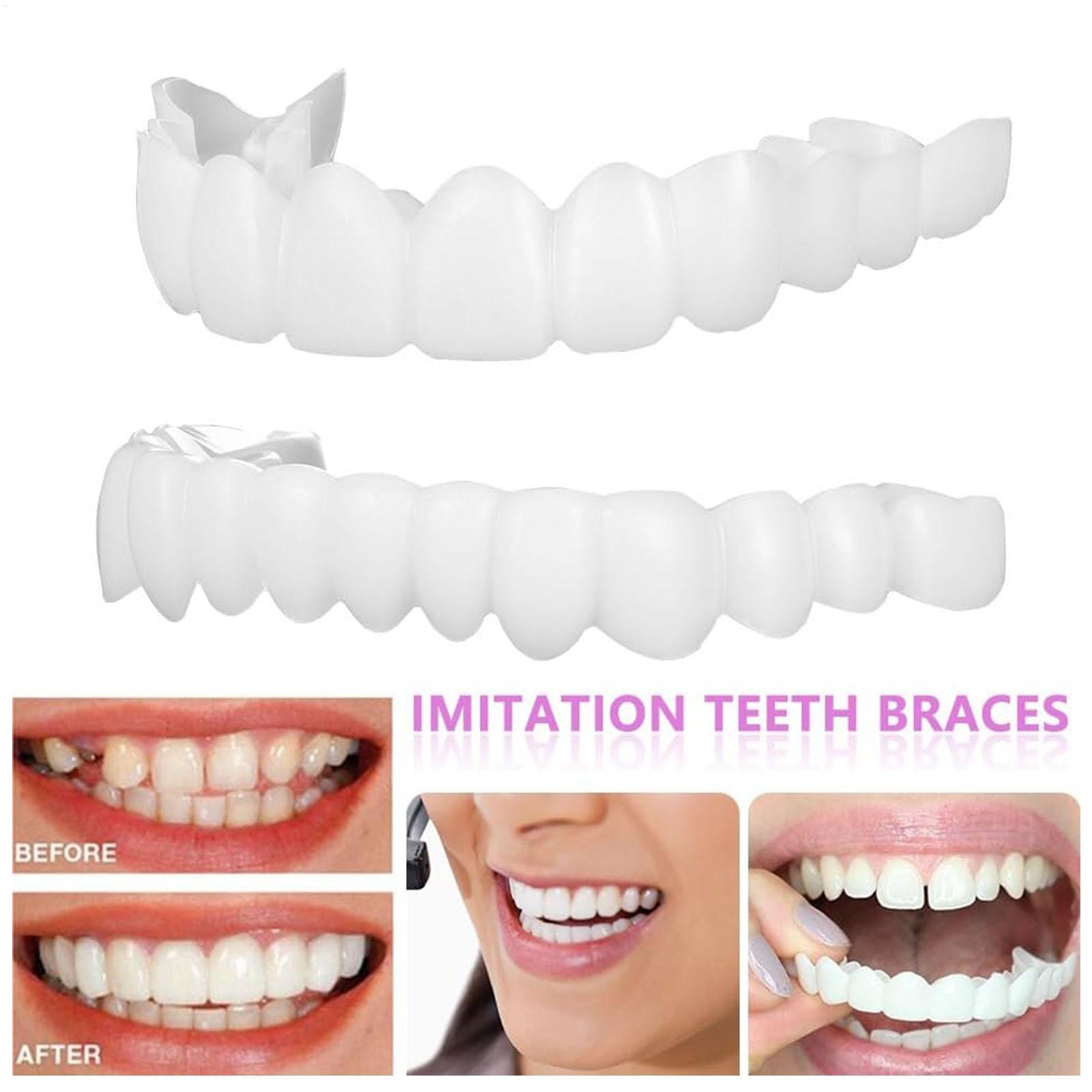 Teeth Whitening With Braces - Penutup Gigi Palsu Atas Bawah, Veneer