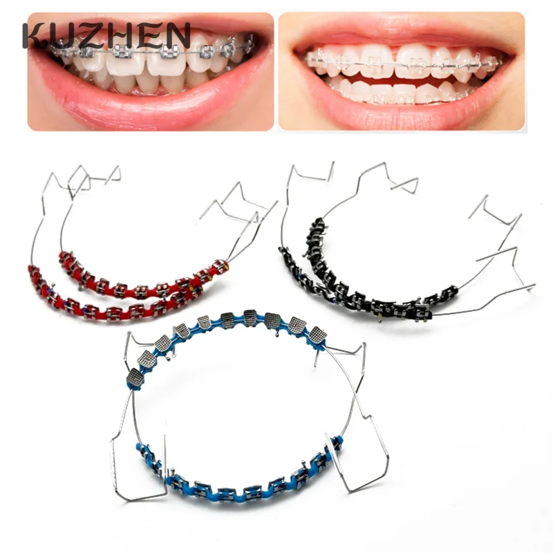 Teeth Whitening With Braces - 1 Pasang Kawat Gigi Palsu Gigi
