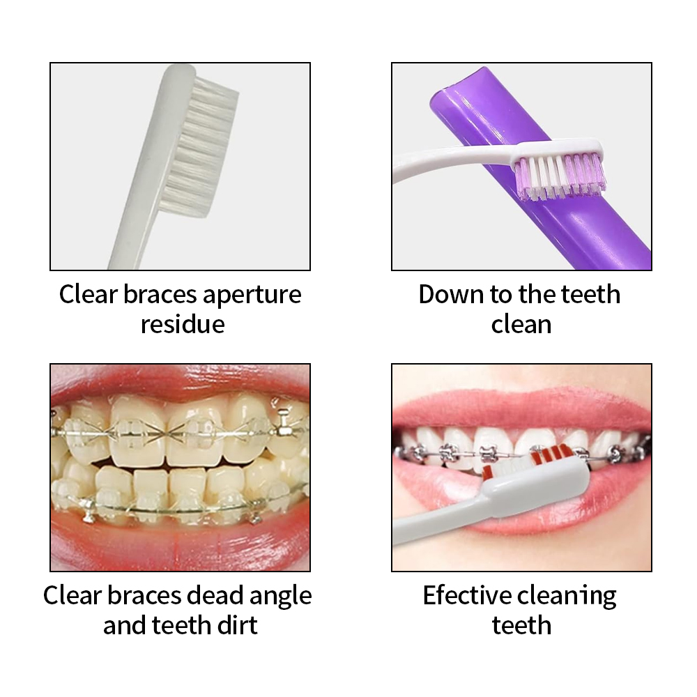Kit sikat gigi, perawatan gigi - Teeth Whitening With Braces ulasan dan harga