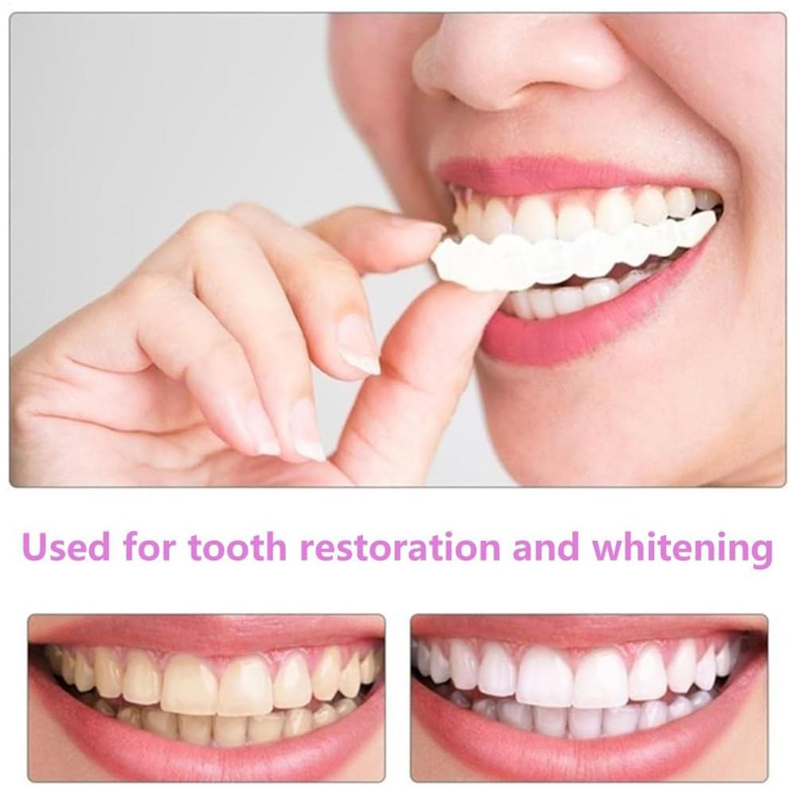 Penutup Gigi Palsu Atas Bawah, - Teeth Whitening With Braces ulasan dan harga