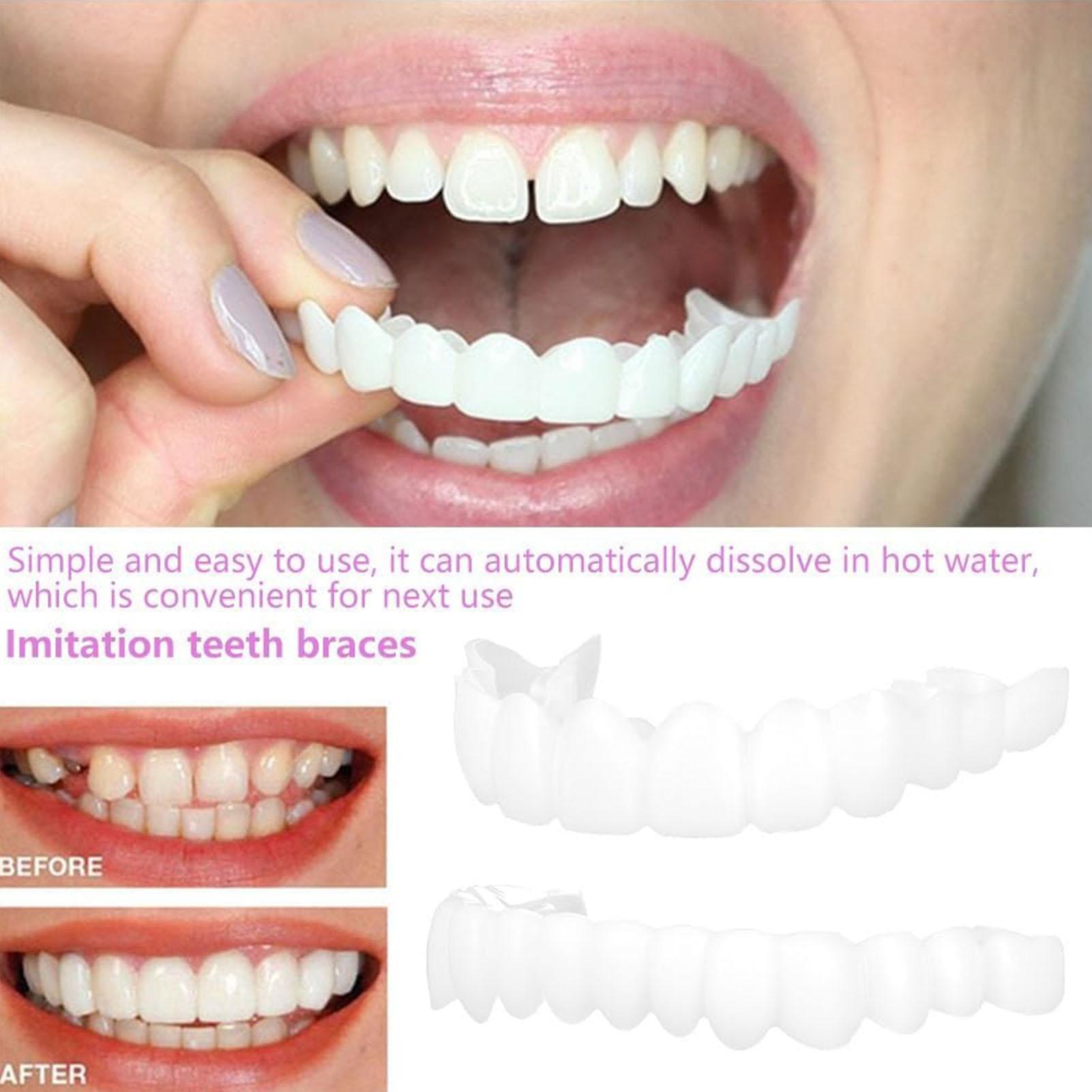Penutup Gigi Palsu Atas Bawah, - Teeth Whitening With Braces ulasan dan harga