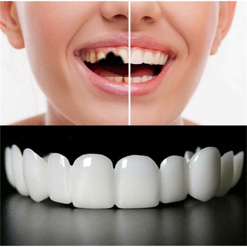 [BARU!ABMK】 2 Pasang, Kembalik - Teeth Whitening With Braces ulasan dan harga