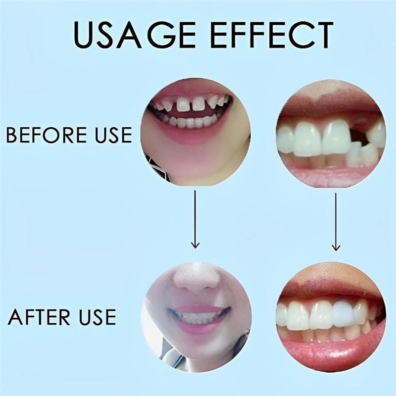 [BARU!ABMK】 2 Pasang, Kembalik - Teeth Whitening With Braces ulasan dan harga